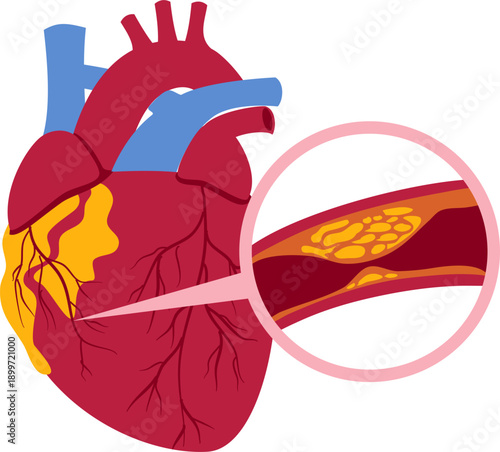 Coronary artery disease medical illustration. Heart blockage and atherosclerosis vector