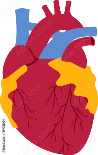 Coronary artery disease medical illustration. Heart blockage and atherosclerosis vector