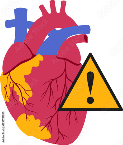 Coronary artery disease medical illustration. Heart blockage and atherosclerosis vector