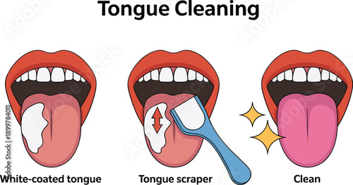 Tongue cleaning medical illustration showing white coated tongue treatment with scraper for oral hygiene fresh breath and dental health care
