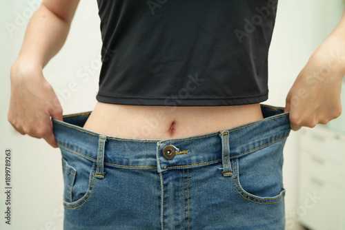 Asian woman with cellulite on leg skin fat, overweight problem.