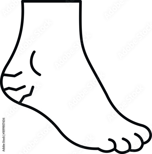 Human foot illustrating foot health problem with cracked dry skin on heel