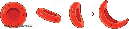 Illustration showing the transformation sequence of a healthy biconcave red blood cell into a deformed sickle cell shape representing anemia pathology