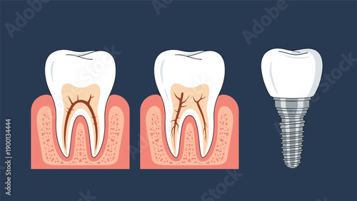 Medical illustration showing stages of tooth decay alongside a modern dental implant and crown for oral health education.
