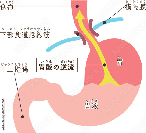 胃酸の逆流のイラスト　Acid reflux illustration