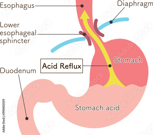 胃酸の逆流のイラスト　Acid reflux illustration