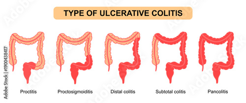 Illustration types of ulcerative colitis. Inflammation of the human digestive system. Inflammatory bowel disease, Inflammation of the human digestive system. Flat Vector illustration for medical