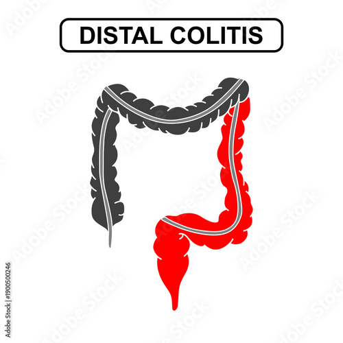 Illustration of Distal colitis, ulcerative colitis. Inflammation of the human digestive system. Inflammatory bowel disease, Inflammation of the human digestive system. Medical Vector illustration
