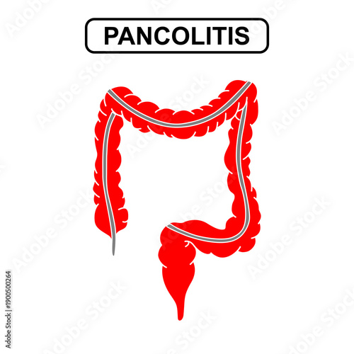 Illustration of pancolitis, ulcerative colitis. Inflammation of the human digestive system. Inflammatory bowel disease, Inflammation of the human digestive system. Vector illustration for medical