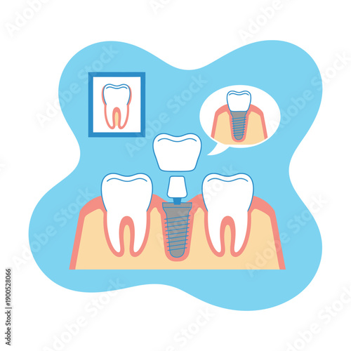 An illustration of a dental implant procedure with a detailed cross-section of teeth and gums.