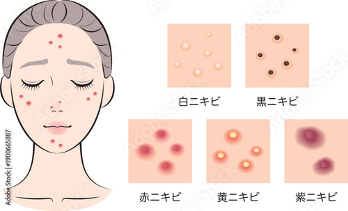 ニキビ顔の女性（ニキビ５タイプ）