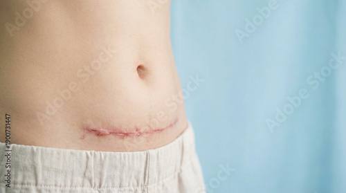Cesarean Section Scar on Woman's Abdomen  
