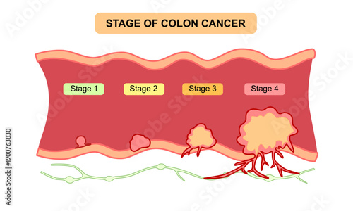 Stage of colon cancer illustration. Concept of colorectal cancer progression. Spread of tumor to lymph nodes. Flat vector illustration for clinics, education, and science.