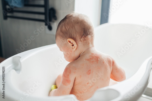 Atopic dermatitis skin care routine. Bathing little baby girl with eczema. Red dry itchy spots on child's body. Taking care of kid