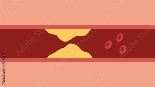 Atherosclerosis artery illustration with blood cells