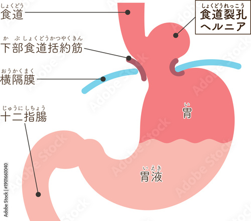 食道裂孔ヘルニアのイラスト　Hiatal hernia illustration