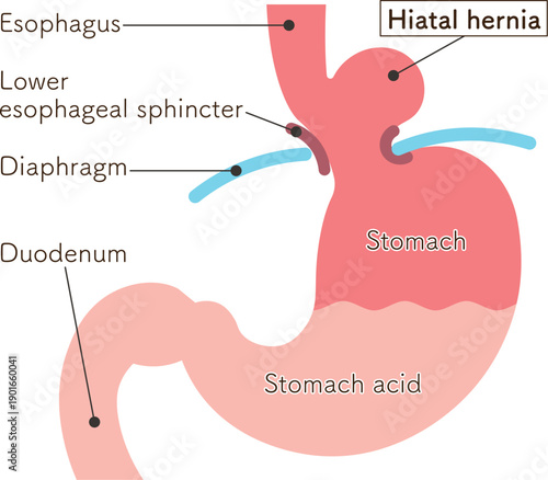食道裂孔ヘルニアのイラスト　Hiatal hernia illustration