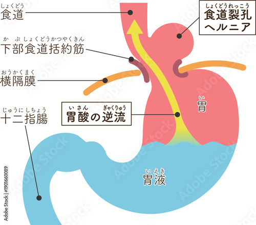 食道裂孔ヘルニアのイラスト　Hiatal hernia illustration