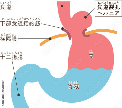 食道裂孔ヘルニアのイラスト　Hiatal hernia illustration