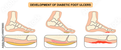 Development of diabetic foot ulcers. Superficial callus formation, pressure on the foot, inflammation and bleeding, ulcer expansion, deep ulcer. Flat vector illustration for medical and education