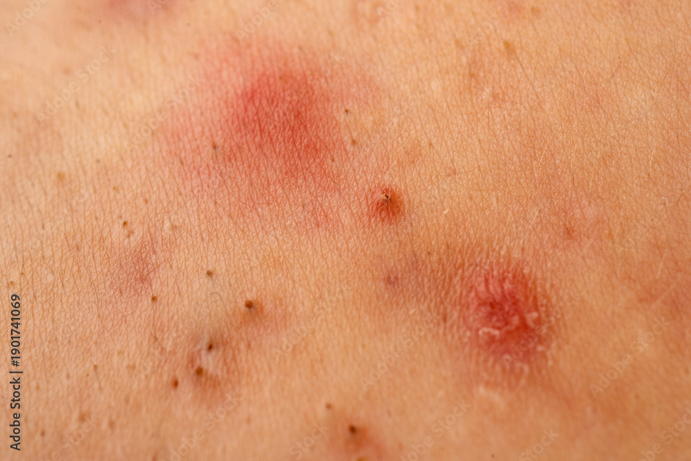 Fototapeta premium Pimple close up with pore texture detail on skin. Acne close up shows pimple with whitehead comedone and sebum. Pimple acne close up for dermatology. Close up acne skin problem with papules.