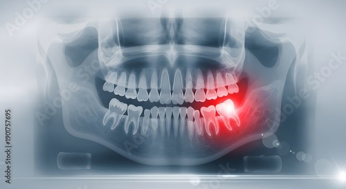 Impacted molar tooth and dental jaw pain diagnostics. Oral health and orthodontic treatment. Panoramic xray of human teeth with red light indicating a painful wisdom tooth eruption