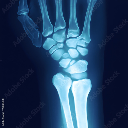 Human wrist and forearm bones xray image in blue tone transparent background