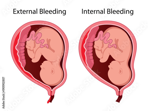 Placental abruption. Detachment of the placenta during pregnancy. Vector medical illustration
