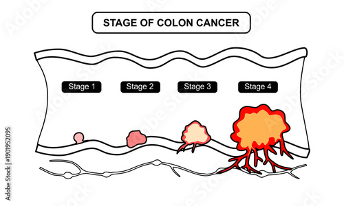 Stage of colon cancer illustration. Concept of colorectal cancer progression. Spread of tumor to lymph nodes. Drawing line vector illustration for clinics, education, and science.
