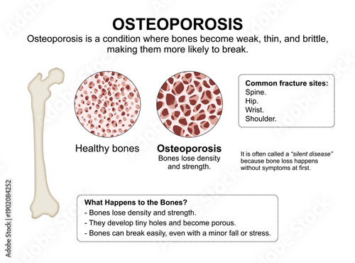 Osteoporosis Patient Bone Education Flashcard