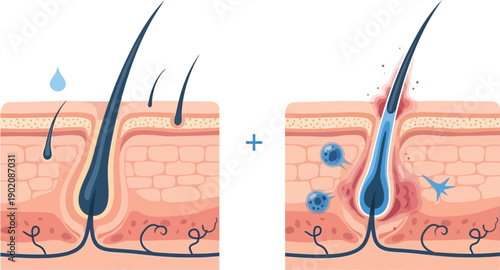 Skin hair follicle anatomy with and without inflammation