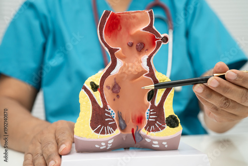 Fotografia Asian doctor with rectum and hemorrhoid human model, inflamed vascular structure