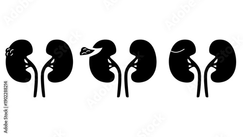 nephrectomy kidney, black isolated silhouette