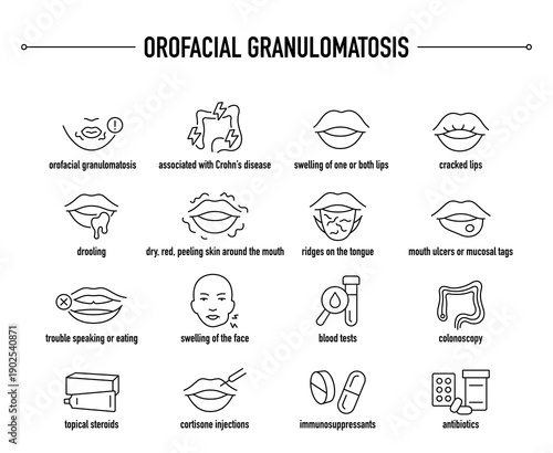 Orofacial Granulomatosis symptoms, diagnostic and treatment vector icon set
