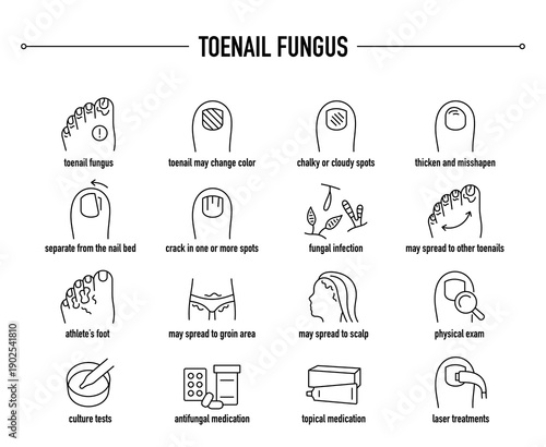 Toenail Fungus symptoms, diagnostic and treatment vector icon set