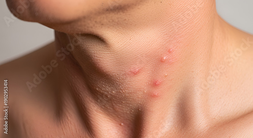 Wallpaper Mural Close-up of a person's neck with red acne pimples and inflamed skin, highlighting a common dermatological issue. Torontodigital.ca