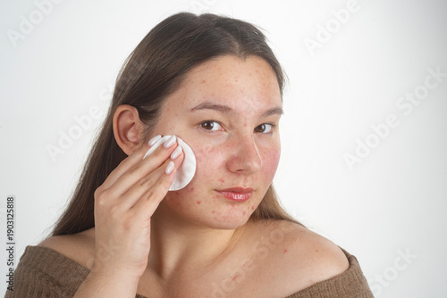 Obraz na plátně Acne treatment with cotton pad for skincare