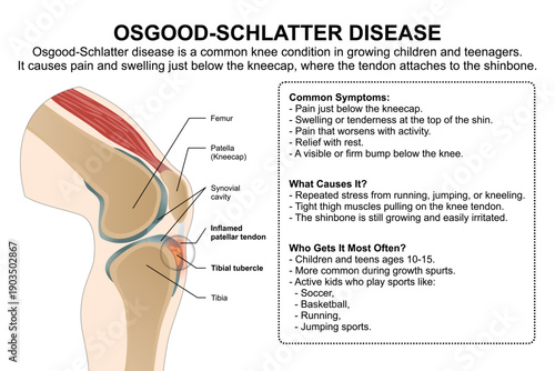 Osgood–Schlatter Disease Education Flashcard