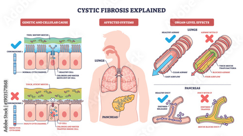 Cystic fibrosis explained, visual summary of CFTR mutation causing thick mucus in lungs and pancreas, contrasting clear and blocked airways to show disease effects. Outline diagram