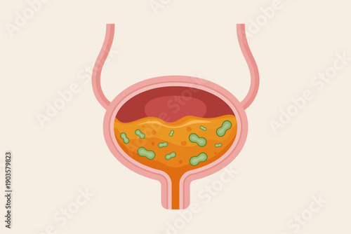 Anatomical of a bladder filled with murky orange liquid and green bacteria anatomy