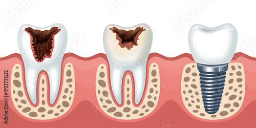 Tooth decay and dental implant process illustration with gum and bone structure