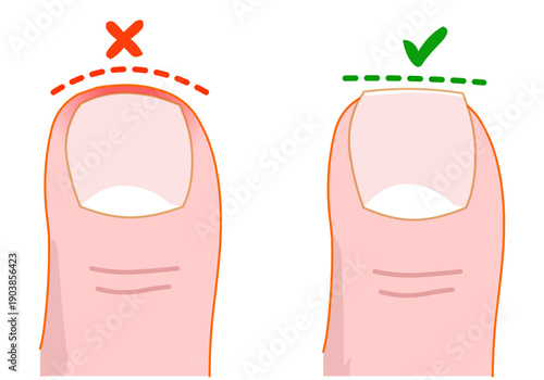 Correct, incorrect fingernail cut. Cut nail on leg wrong and right, health pedicure. Nail fold infections. Illustration vector