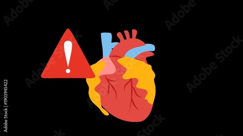 Coronary artery disease medical illustration. Heart blockage and atherosclerosis animation