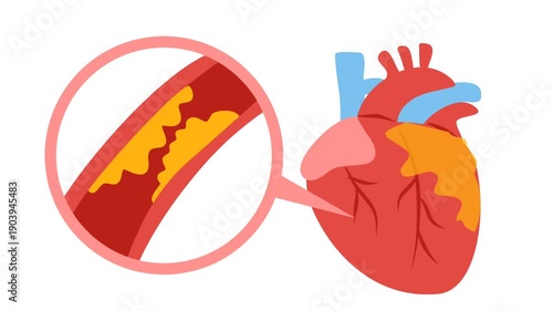 Coronary artery disease medical illustration. Heart blockage and atherosclerosis animation