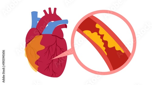 Coronary artery disease medical illustration. Heart blockage and atherosclerosis animation