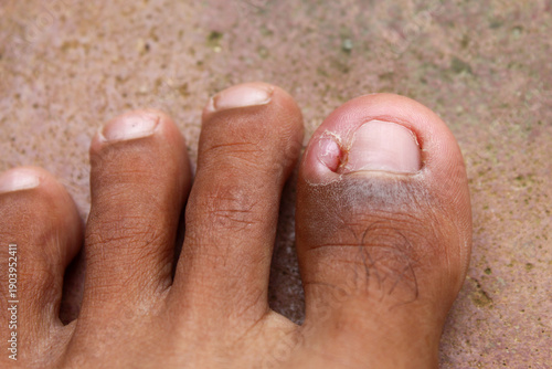 Obraz na plátně A person's big toe is inflamed, red, and swollen around the nail (hanging nail)