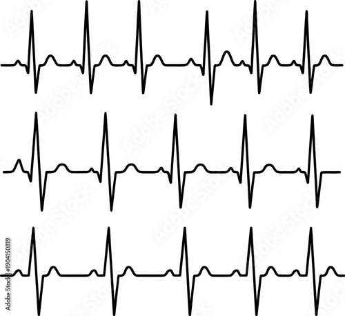 Three distinct electrocardiogram (ecg) tracings illustrating different heart rhythms Vector