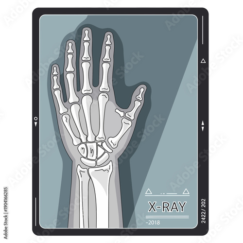 Human hand x-ray image on screen