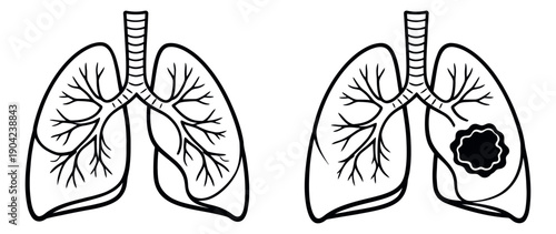 Simple line art human lungs set featuring normal and cancerous conditions for medical and health awareness