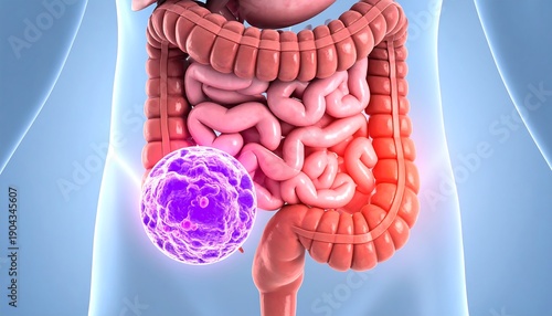 3D illustration of a cancerous tumor cell attacking the human digestive system.